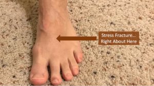 Read more about the article It’s A Stress Fracture